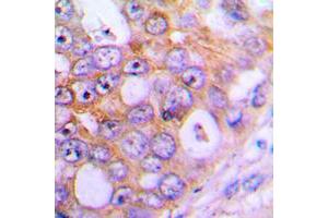 Immunohistochemical analysis of CHML staining in human lung cancer formalin fixed paraffin embedded tissue section. (CHML 抗体  (Center))