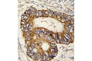 Formalin-fixed and paraffin-embedded human colon carcinoma tissue reacted with PHB2 Antibody , which was peroxidase-conjugated to the secondary antibody, followed by DAB staining.
