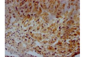 IHC image of ABIN7147174 diluted at 1:500 and staining in paraffin-embedded human glioma tissue performed on a Leica BondTM system. (CD63 抗体  (AA 103-203))