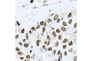 Immunohistochemical analysis of METTL3 staining in human lung cancer formalin fixed paraffin embedded tissue section. (METTL3 抗体)