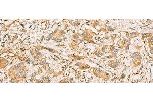 Immunohistochemistry of paraffin-embedded Human liver cancer tissue using MRPS35 Polyclonal Antibody at dilution of 1:60(x200) (MRPS35 抗体)