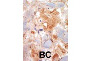 Formalin-fixed and paraffin-embedded human cancer tissue reacted with KIT polyclonal antibody  , which was peroxidase-conjugated to the secondary antibody, followed by DAB staining. (KIT 抗体  (N-Term))