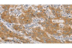 Immunohistochemistry of paraffin-embedded Human gastic cancer using ARHGEF7 Polyclonal Antibody at dilution of 1:40 (ARHGEF7 抗体)