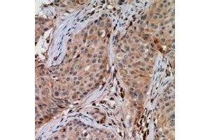 Immunohistochemical analysis of UBE2G1 staining in human breast cancer formalin fixed paraffin embedded tissue section. (UBE2G1 抗体)