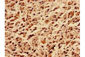 Immunocytochemistry analysis of human glioma using ABIN7142719 at dilution of 1:100 (50S Ribosomal Protein L16 (RplP) (AA 1-317) 抗体)