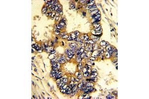 Formalin-fixed and paraffin-embedded human colon carcinoma with EPN3 Antibody (N-term), which was peroxidase-conjugated to the secondary antibody, followed by DAB staining. (EPN3 抗体  (N-Term))