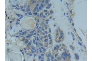 Detection of TNFR1 in Human Lung cancer Tissue using Polyclonal Antibody to Tumor Necrosis Factor Receptor 1 (TNFR1)