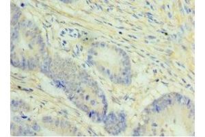 Immunohistochemistry of paraffin-embedded human colon cancer using ABIN7148434 at dilution of 1:100 (NCAPH 抗体  (AA 1-250))