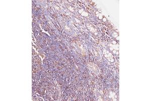 Immunohistochemical analysis of C on paraffin-embedded Human colon carcinoma tissue. (Glucuronidase beta 抗体  (AA 335-362))