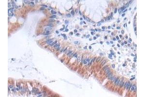 Detection of GLTP in Human Stomach cancer Tissue using Polyclonal Antibody to Glycolipid Transfer Protein (GLTP) (GLTP 抗体  (AA 2-209))