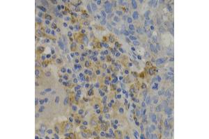 Immunohistochemistry of paraffin-embedded human lung cancer using PAK1 Antibody. (PAK1 抗体)