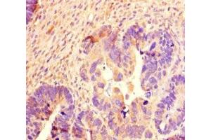 Immunohistochemistry of paraffin-embedded human ovarian cancer using ABIN7168711 at dilution of 1:100 (SCG2 抗体  (AA 31-617))