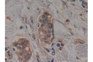 Detection of TTK in Human Breast cancer Tissue using Polyclonal Antibody to TTK Protein Kinase (TTK)