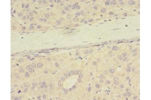 Immunohistochemistry of paraffin-embedded human liver cancer using ABIN7165968 at dilution of 1:100 (PPME1 抗体  (AA 201-386))