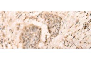 Immunohistochemistry of paraffin-embedded Human esophagus cancer tissue using ELP4 Polyclonal Antibody at dilution of 1:25(x200) (ELP4 抗体)