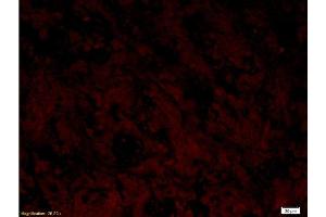 Formalin-fixed and paraffin embedded labeled with human gastric carcinoma Rabbit Anti-AIF Polyclonal Antibody, Unconjugated  1:300 followed by conjugation to the secondary antibody Goat Anti-Rabbit IgG, PE (Negative Control)