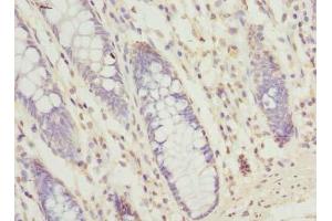Immunohistochemistry of paraffin-embedded human colon cancer using SEC61G Antibody at a dilution of 1:100 (SEC61G 抗体  (AA 1-32))