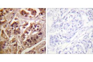 Peptide - +Immunohistochemistry analysis of paraffin-embedded human breast carcinoma tissue using GRF-1 antibody. (GRLF1 抗体)
