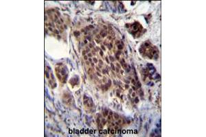 FRAT2 Antibody immunohistochemistry analysis in formalin fixed and paraffin embedded human bladder carcinoma followed by peroxidase conjugation of the secondary antibody and DAB staining.