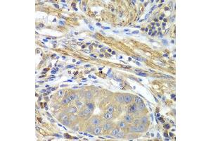 Immunohistochemistry of paraffin-embedded human gastric cancer using PICK1 antibody at dilution of 1:100 (x40 lens). (PICK1 抗体)