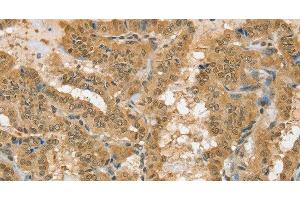 Immunohistochemistry of paraffin-embedded Human thyroid cancer using PSMC1 Polyclonal Antibody at dilution of 1:40 (PSMC1 抗体)