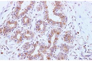 Immunohistochemistry of paraffin-embedded Human breast using BRCA2 Polyclonal Antibody at dilution of 1:100