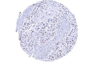 Distinct nucleolar immunostaining in the nucleoli of an esophageal squamous cell carcinoma (Recombinant Nucleolin 抗体)