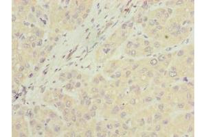 Immunohistochemistry of paraffin-embedded human liver cancer using ABIN7157067 at dilution of 1:100 (NUBPL 抗体  (AA 39-319))
