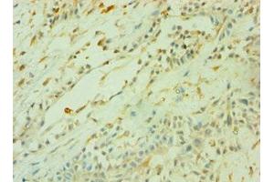 Immunohistochemistry of paraffin-embedded human breast cancer using ABIN7160470 at dilution of 1:100 (CD33 抗体  (AA 49-259))