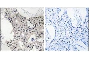 Immunohistochemistry analysis of paraffin-embedded human breast carcinoma, using BAGE4 Antibody. (BAGE4 抗体  (AA 9-58))