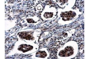 IHC-P Image TSPYL1 antibody detects TSPYL1 protein at nucleus in human breast cancer by immunohistochemical analysis. (TSPYL1 抗体)