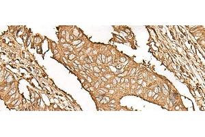 Immunohistochemistry of paraffin-embedded Human colorectal cancer tissue using UBE2A Polyclonal Antibody at dilution of 1:45(x200) (UBE2A 抗体)