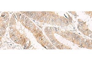Immunohistochemistry of paraffin-embedded Human colorectal cancer tissue using TRAPPC1 Polyclonal Antibody at dilution of 1:50(x200) (TRAPPC1 抗体)