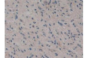 DAB staining on IHC-P; Samples: Human Glioma Tissue (CARD9 抗体  (AA 26-283))