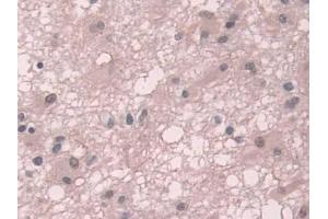 IHC-P analysis of Human Glioma Tissue, with DAB staining. (TKT 抗体  (AA 1-294))