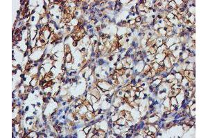 Immunohistochemical staining of paraffin-embedded Carcinoma of Human kidney tissue using anti-TUBAL3 mouse monoclonal antibody. (TUBAL3 抗体  (AA 150-446))