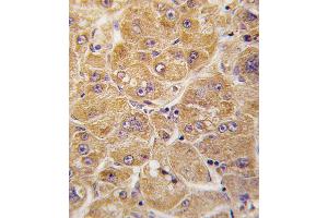 Formalin-fixed and paraffin-embedded human hepatocarcinoma tissue reacted with ALDH1A1 antibody , which was peroxidase-conjugated to the secondary antibody, followed by DAB staining. (ALDH1A1 抗体  (AA 302-331))