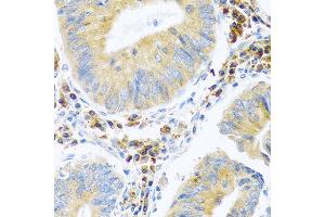 Immunohistochemistry of paraffin-embedded human colon carcinoma using MANF antibody at dilution of 1:100 (40x lens). (MANF 抗体)