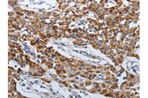The image on the left is immunohistochemistry of paraffin-embedded Human lung cancer tissue using ABIN7192612(SPAG1 Antibody) at dilution 1/25, on the right is treated with synthetic peptide. (SPAG1 抗体)