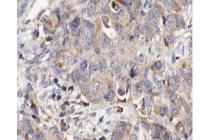 ABIN6266778 at 1/100 staining human ovarian cancer tissue sections by IHC-P. (Fibrillin 1 抗体  (C-Term))