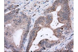 Immunohistochemical staining of paraffin-embedded Adenocarcinoma of Human ovary tissue using anti-BSG mouse monoclonal antibody. (CD147 抗体)