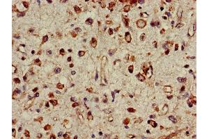 IHC image of ABIN7142234 diluted at 1:500 and staining in paraffin-embedded human glioma performed on a Leica BondTM system. (PSMC4 抗体  (Regulatory Subunit 6B))