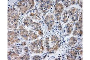Immunohistochemical staining of paraffin-embedded Carcinoma of liver tissue using anti-PLEK mouse monoclonal antibody. (Pleckstrin 抗体)