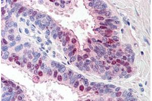 Human Prostate (formalin-fixed, paraffin-embedded) stained with TARBP1 antibody ABIN214523 at 5 ug/ml followed by biotinylated goat anti-rabbit IgG secondary antibody ABIN481713, alkaline phosphatase-streptavidin and chromogen. (TARBP1 抗体  (Internal Region))