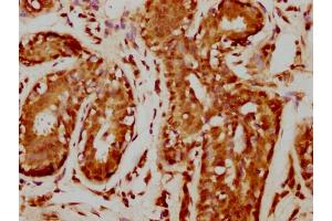 IHC image of nforHU diluted at 1:20 and staining in paraffin-embedded human breast cancer performed on a Leica BondTM system. (HIST1H1C 抗体  (AA 100-112))