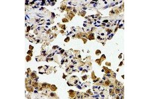 Immunohistochemical analysis of Cystatin A staining in human lung cancer formalin fixed paraffin embedded tissue section. (CSTA 抗体)