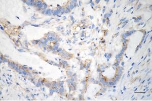 Immunohistochemistry was performed on paraffin-embedded human sigmoid colon carcinoma using interferon induced transmembrane protein 3 antibody (ABIN7799091), 1:200). (Recombinant IFITM3 抗体)