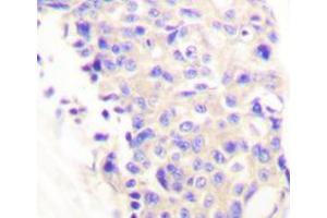 Immunohistochemistry analyzes of PLC γ1 antibody in paraffin-embedded human breast carcinoma tissue. (Phospholipase C gamma 1 抗体)