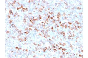 Formalin-fixed, paraffin-embedded Melanoma stained with Tyrosinase Mouse Recombinant Monoclonal Antibody (rOCA1/812). (Recombinant TYR 抗体)