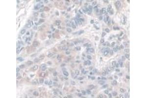 IHC-P analysis of Human Liver Cancer Tissue, with DAB staining. (HPR 抗体  (AA 70-332))